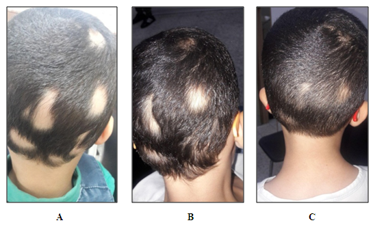 Sesame and Pumpkin Seed Oil are New Effective Topical Therapies for  Alopecia Areata
