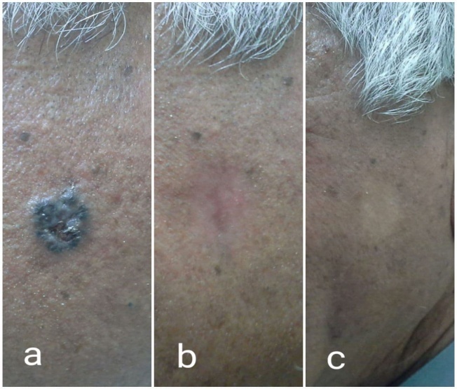 A Comparative Study of Surgical Excision Versus Curettage and Cautery in the Treatment of Basal Cell Carcinoma Aesthetic Outcome, Complication and Recurrence