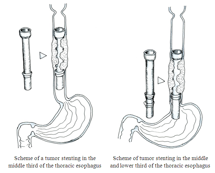 Stenting Results Of Patinets With Esophageal Tumors Complicated By ...