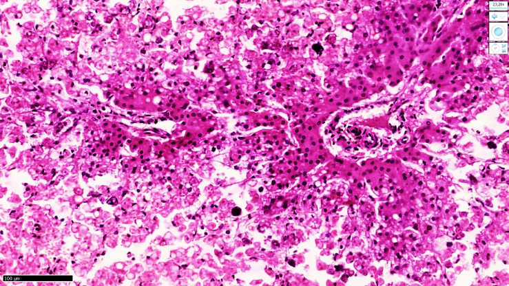 Morphological Changes of the Liver of Infants Born in Pregnancy with ...