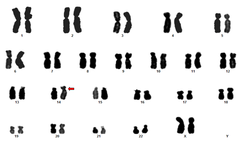 robertsonian translocation karyotype