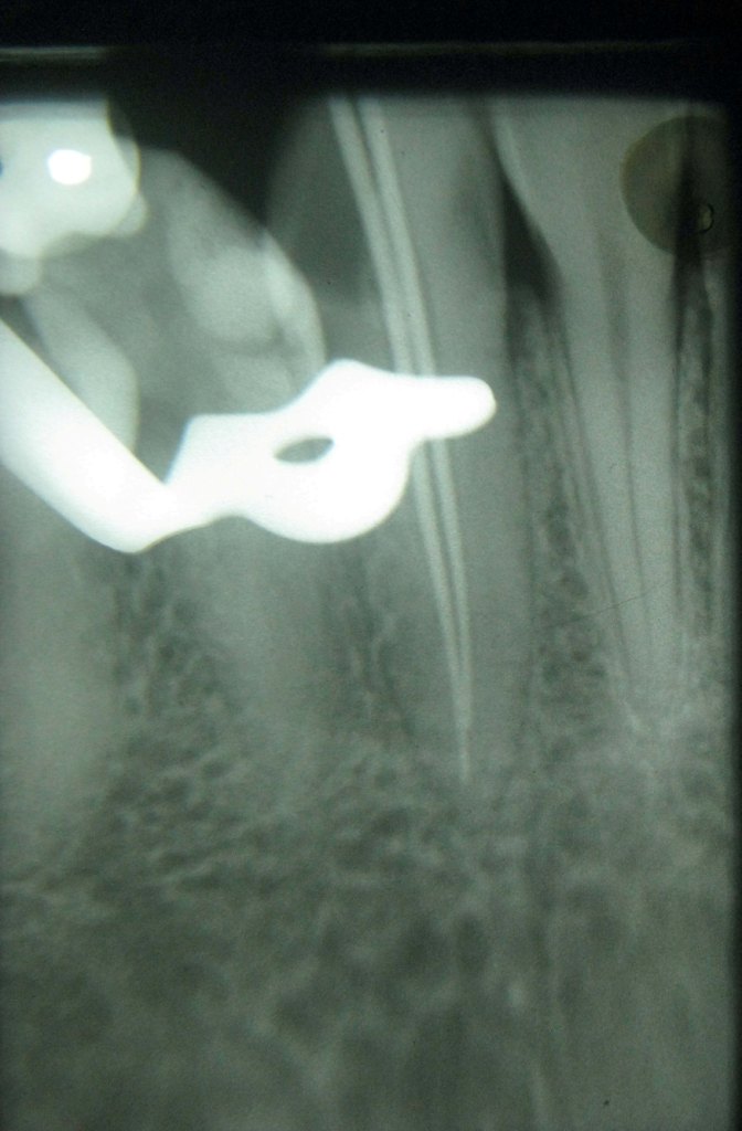 Mandibular Canine with Two Root Canals – An Unusual Case Report