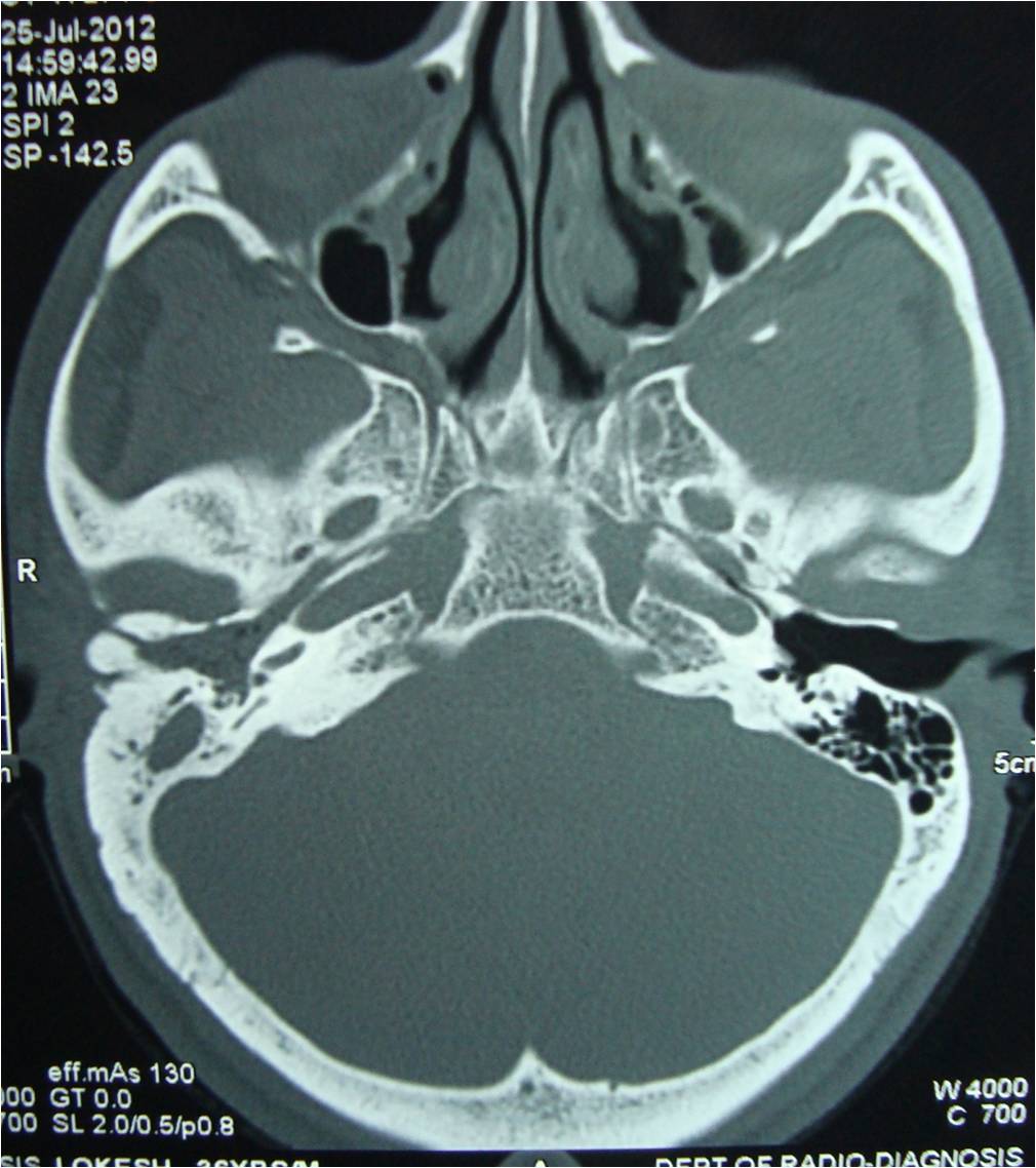 osteomas ear canal