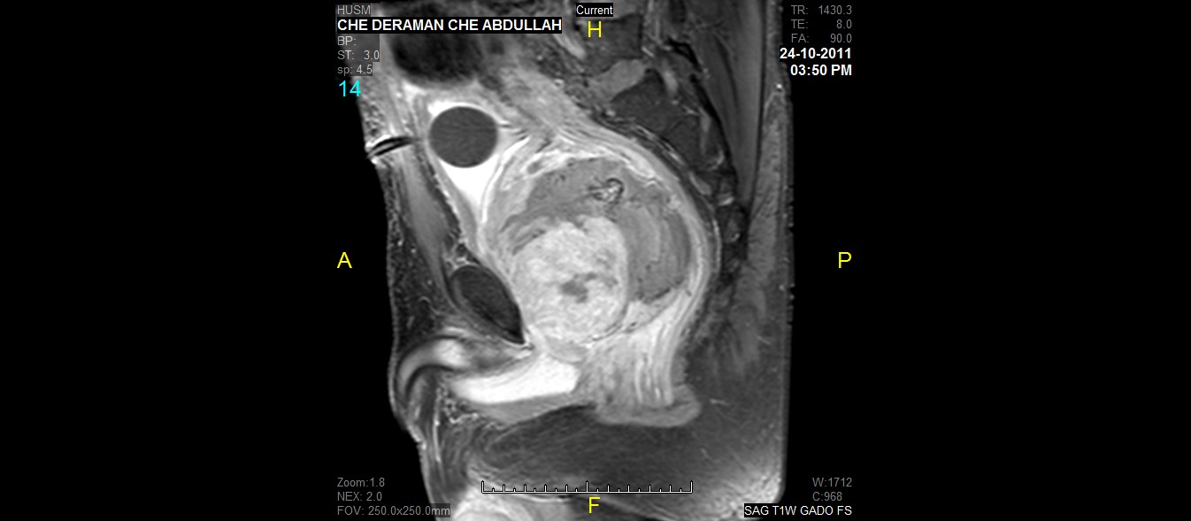 prostate sarcoma mri