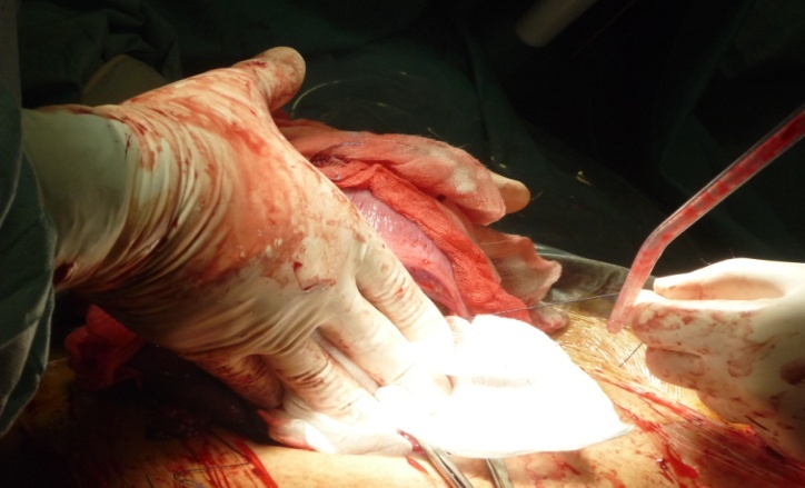 Asymptomatic Complete Placenta Previa: A Case Report and ...