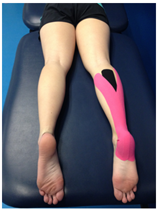 The effect of Kinesio-tape® on pain and vertical jump performance in active  individuals with patellar tendinopathy - ScienceDirect